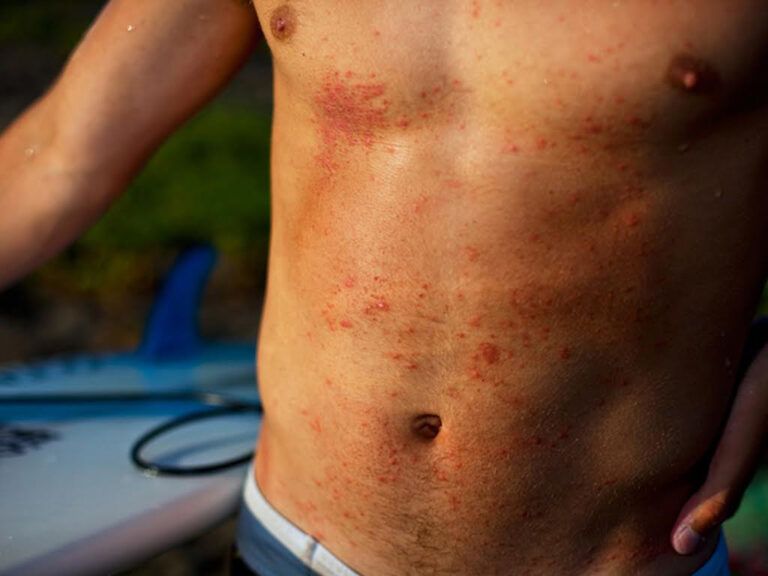 How to Treat Surf Rash Holistic and Store Bought Solutions!